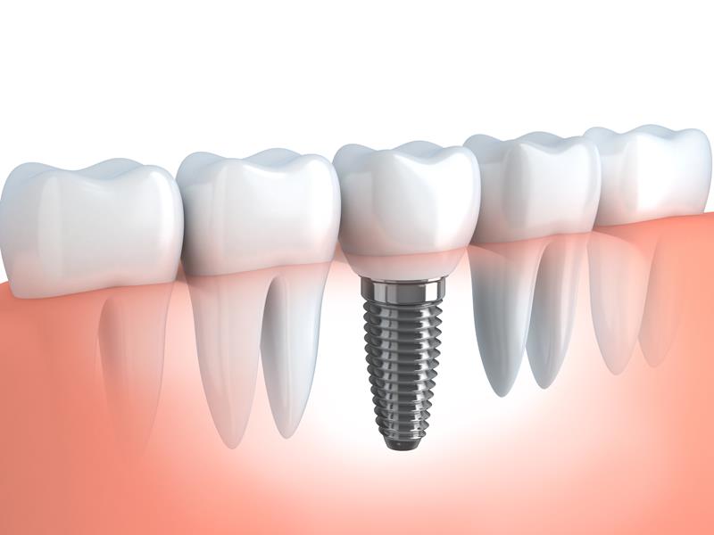 Dental Implants  Pewaukee, WI 