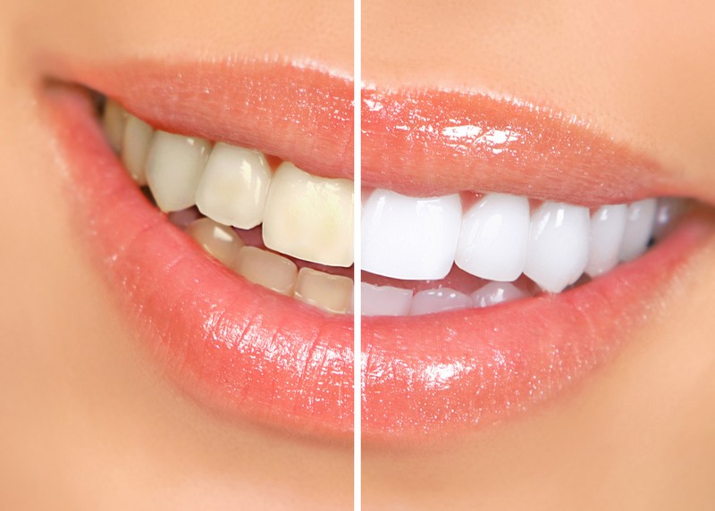 Teeth Whitening  Pewaukee, WI